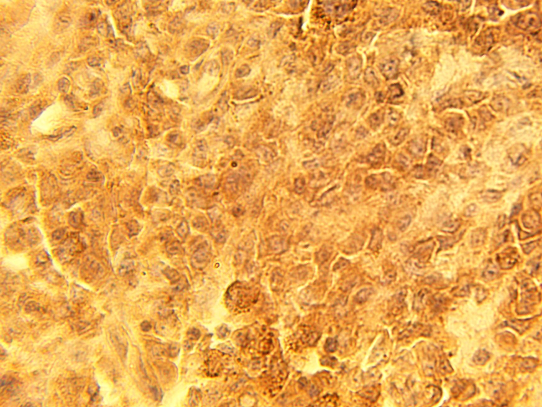 Immunohistochemical staining of human melanoma tissue using affinity purified CSP alpha antibody (Cat. No. X2667P) at 15 µg/ml.